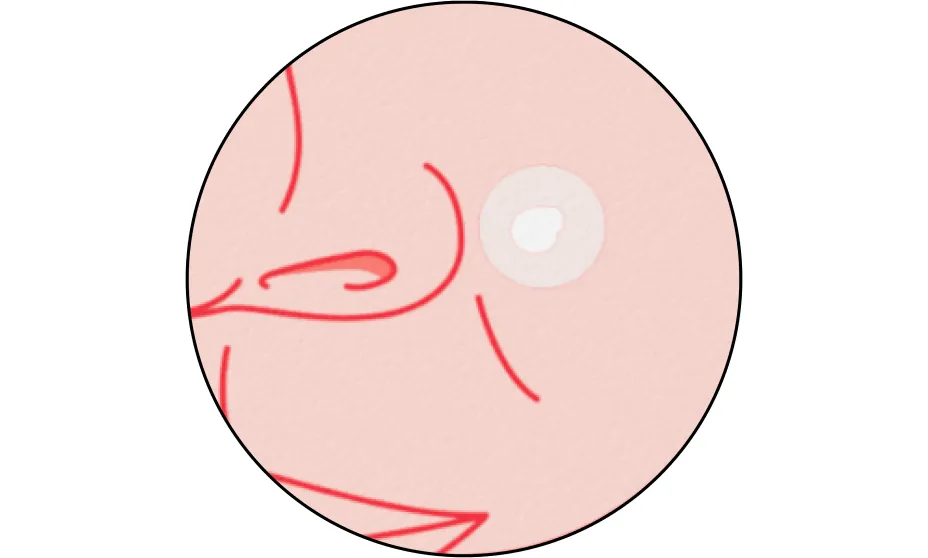 Neutrogena® Mini Acne Patch, Sensitive Skin product image 14