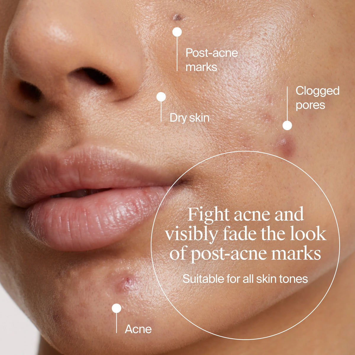 Neutrogena® Acne-Fighting Skincare Solutions Regimen Duo product image 6