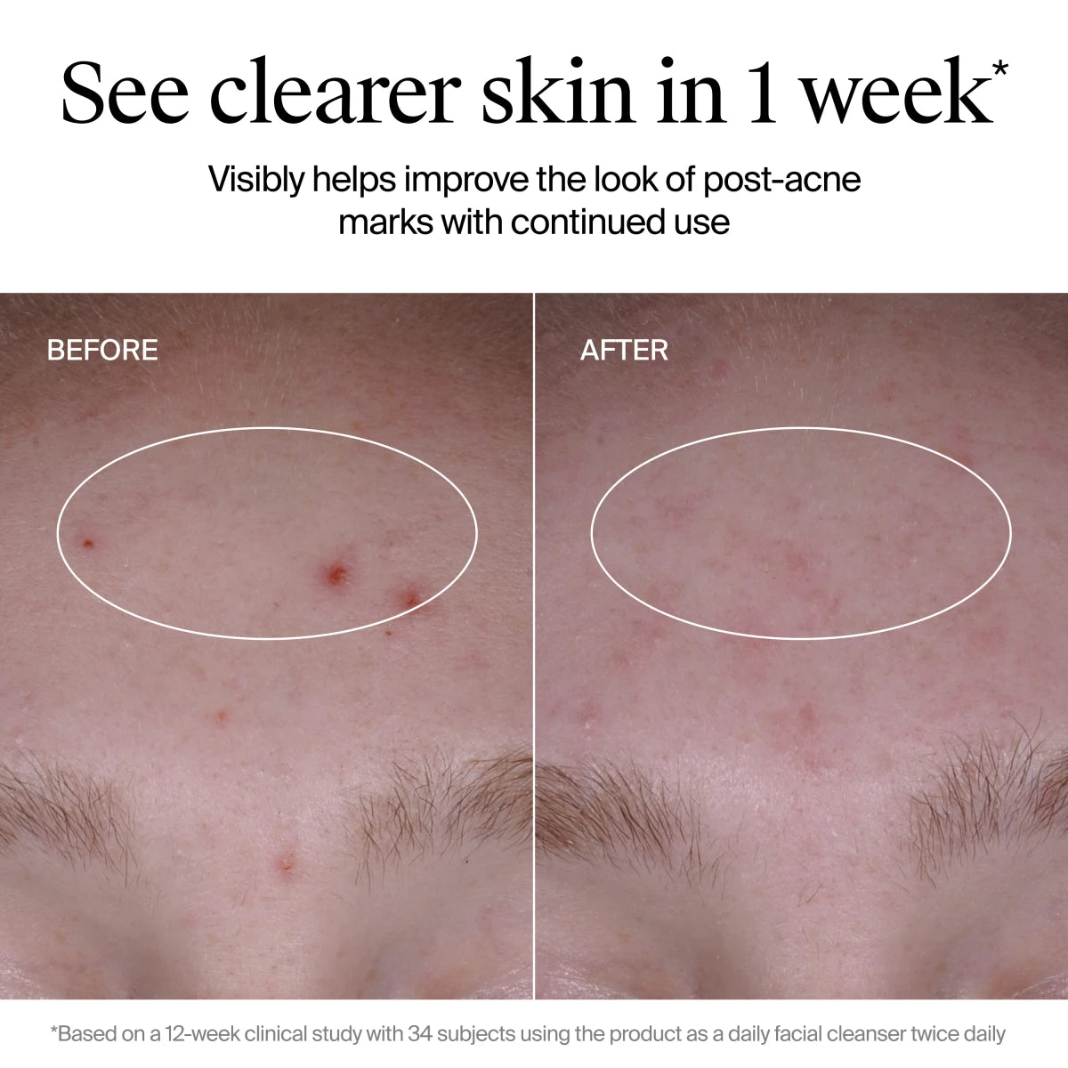 Neutrogena® Evenly Clear™ Acne Cleanser product image 6