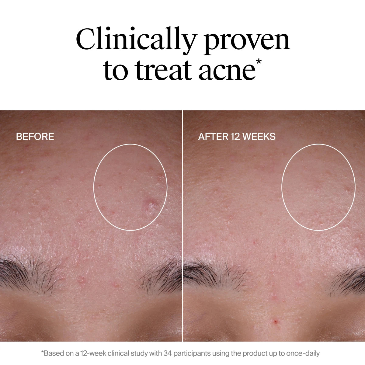 Neutrogena® Evenly Clear™ Acne Exfoliant product image 6