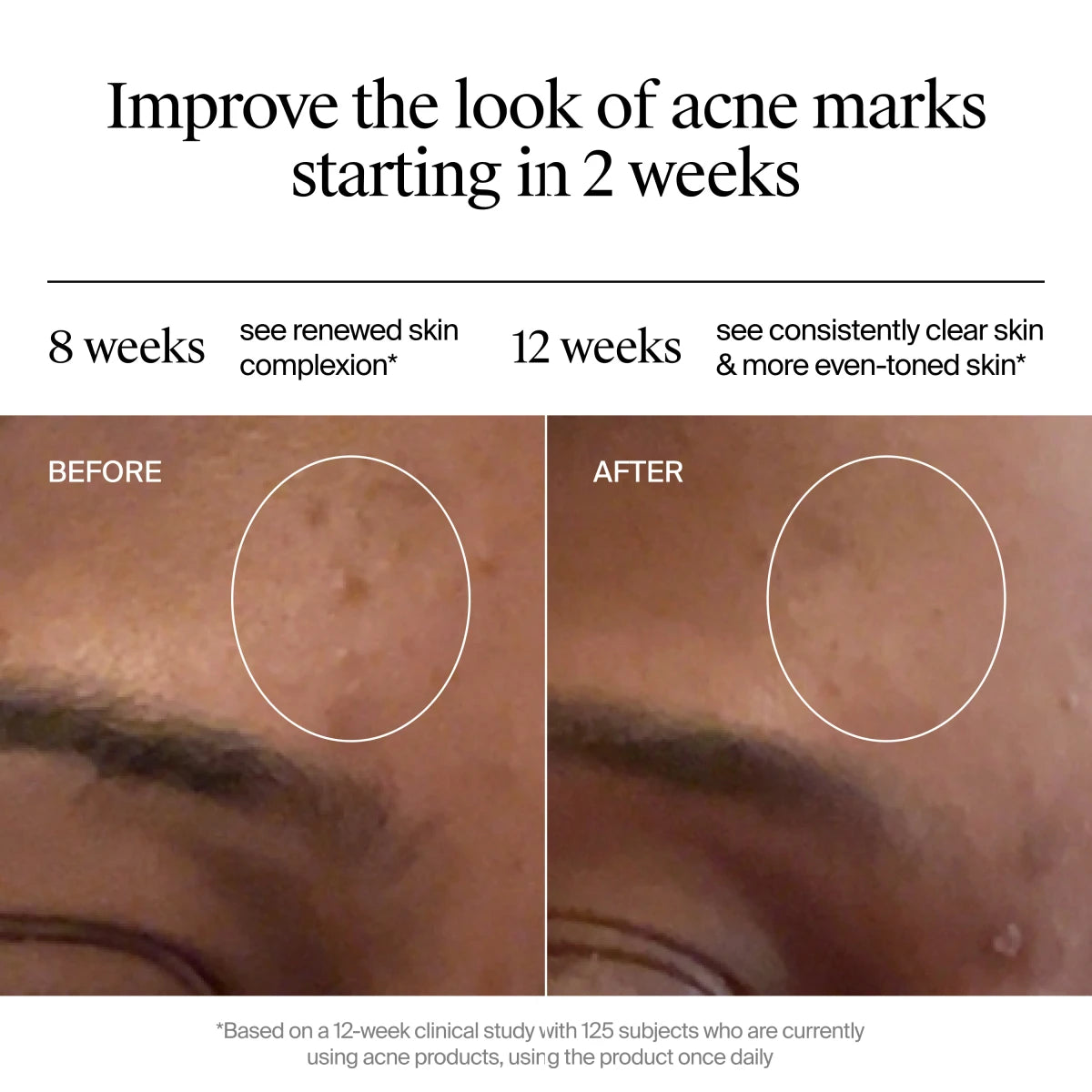Neutrogena® Evenly Clear™ Retinoid Adapalene Gel 0.1% Acne Treatment product image 5