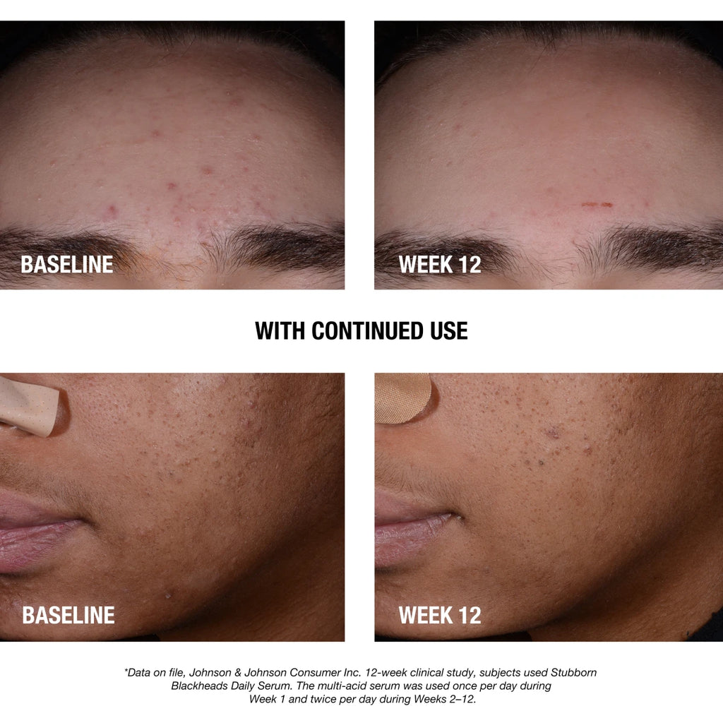 Neutrogena® Stubborn Blackheads Daily Acne Facial Serum product image 3