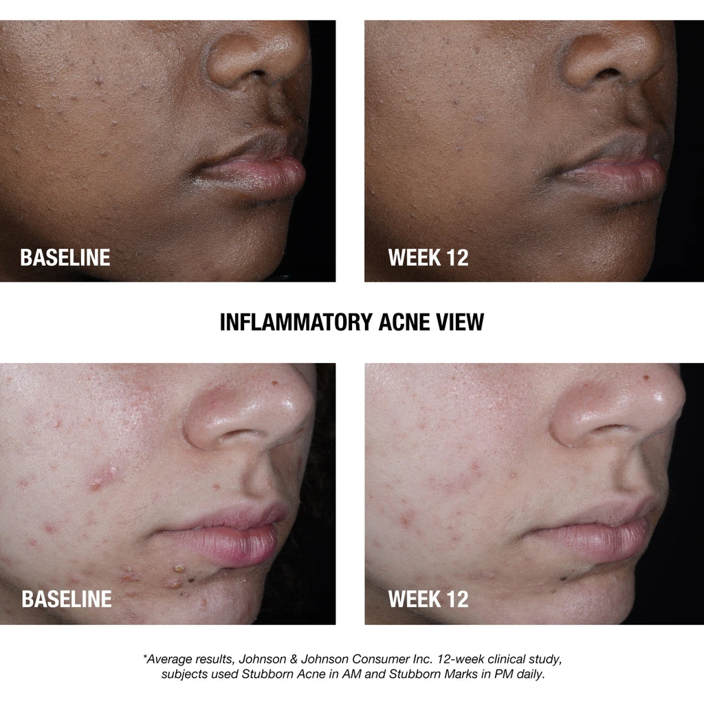 Neutrogena® Stubborn Acne AM Treatment product image 3