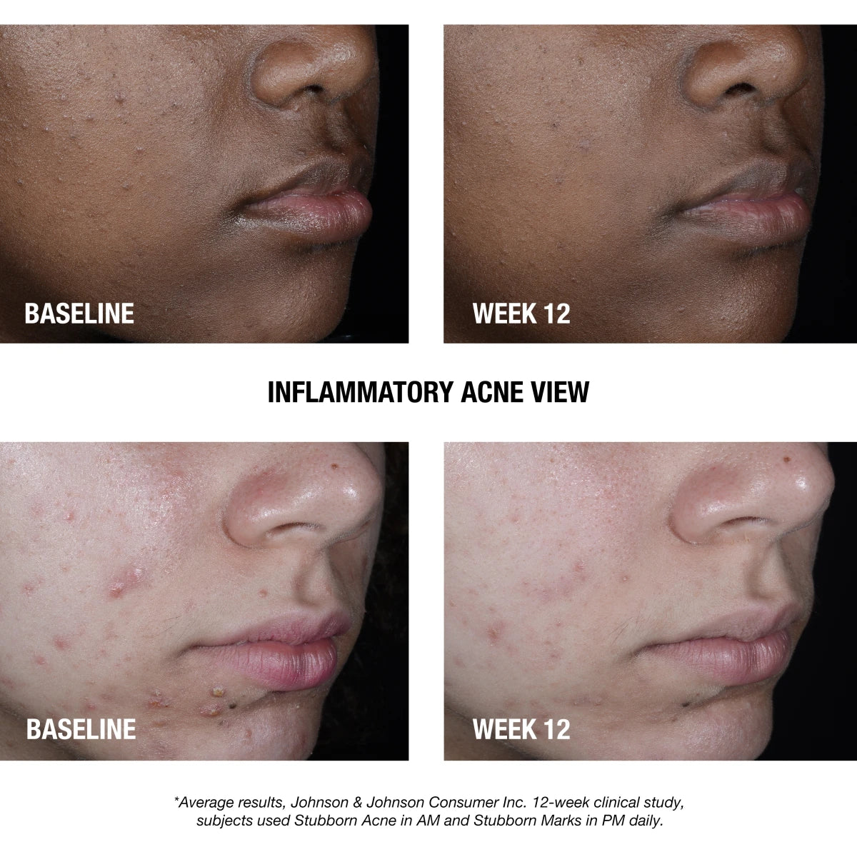 Neutrogena® Stubborn Acne AM Treatment product image 3