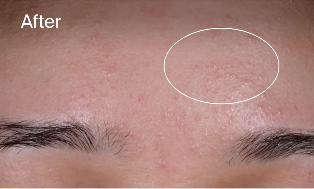 Neutrogena® Evenly Clear™ Acne Exfoliant product image 13