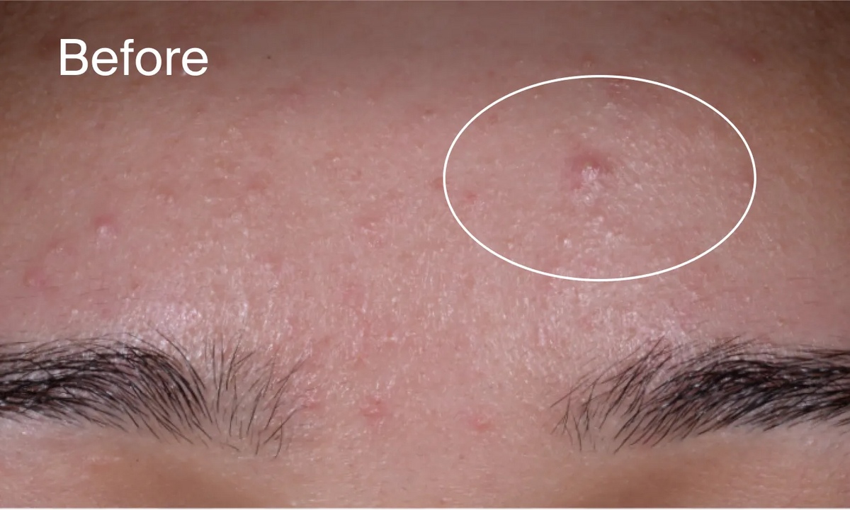 Neutrogena® Evenly Clear™ Acne Exfoliant product image 12