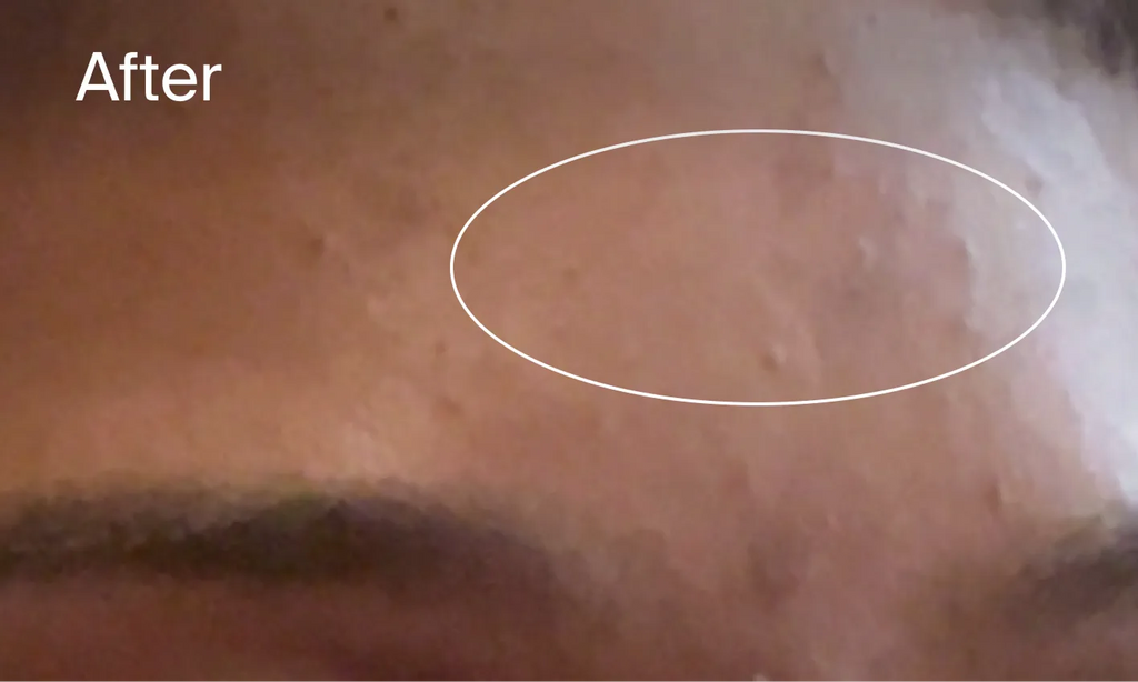 Neutrogena® Evenly Clear™ Retinoid Adapalene Gel 0.1% Acne Treatment product image 13