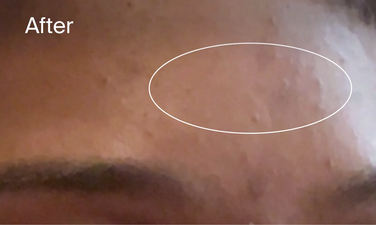 Neutrogena® Evenly Clear™ Retinoid Adapalene Gel 0.1% Acne Treatment product image 13