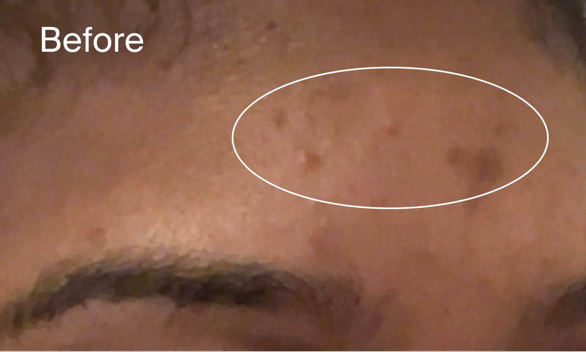 Neutrogena® Evenly Clear™ Retinoid Adapalene Gel 0.1% Acne Treatment product image 12